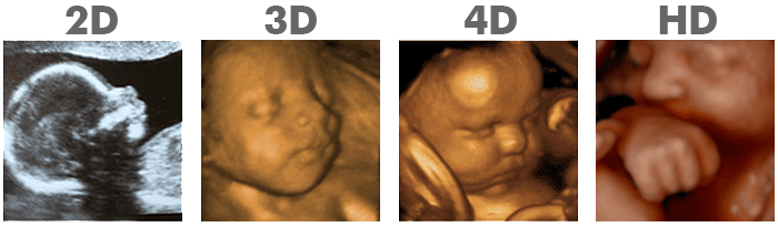 2d ultrasound, 3d ultrasound, 4d ultrasound, hd ultrasound